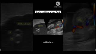 SUA single umbilical artery என்றால் என்ன இது குழந்தையை எவ்வாறு பாதிக்கிறது tamil [upl. by Doria474]