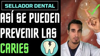 Cómo PREVENIR las CARIES en NIÑOS  SELLADORES de fosetas y FISURAS [upl. by Ettelliw]