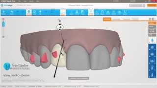 Invisalign ClinCheck Pro Tutorial espaciado con stripping  Ortodoncia Friedländer Barcelona [upl. by Malca]