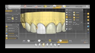 How we produce upper front dental veneers in less than 24 hours using CadCam Technology [upl. by Jesus]