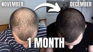 FINASTERIDE MINOXIDIL amp DERMA ROLLING 2 MONTHS INSANE RESULTS [upl. by Yonina]