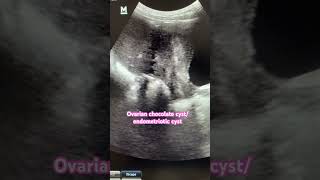 Chocolate cyst  Ovarian endometrioma ultrasound video ovariancysts chocolate ultraradiology [upl. by Ynnus]