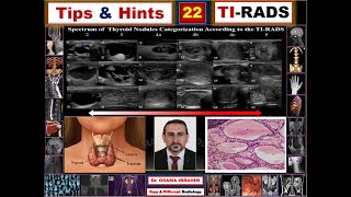 Tips amp Hints 22 TI RADS how to score thyroid nodule [upl. by Johns]