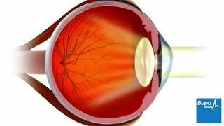 How LASIK eye surgery is carried out [upl. by Llib]