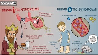 Nephrotic SyndromeNursing [upl. by Hbahsur]