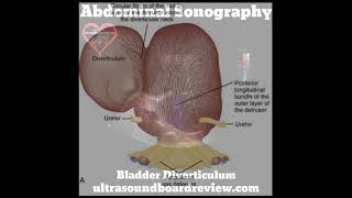 Bladder Diverticulum [upl. by Flossie]