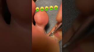 Removing the dead itchy skin from between my toes 🤮 [upl. by Shepley]