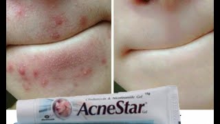 AcneStar Gel Remove Acne  Pimples  BlackheadsComplete Review हिन्दी मैं [upl. by Eire657]