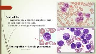 Practical Hematology 11 Morphology of Benign WBCs disorders [upl. by Reilamag]