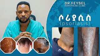 ሶሪያሲስ ምንድነው Psoriasis Dr Feysel [upl. by Enom]