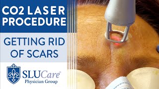 CO2 Laser Resurfacing Treatment For Getting Rid of Scars  Full Procedure [upl. by Ahsienek813]