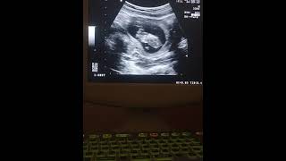 ultrasound fetal anomaly Anencephaly 12 weeks [upl. by Einnor]