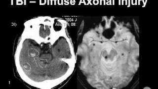 Diagnosing Brain Hemorrhages [upl. by Sheila]