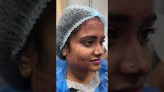 botox cosmeticsurgery cosmology cure drpayalhomeocare viralshort viralvideo youtubeshorts [upl. by Nirok888]