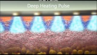 TriFractional antiaging RF technology animation [upl. by Jon177]