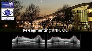 RNFL Resegmentation for Heidelberg Spectralis [upl. by Charity]