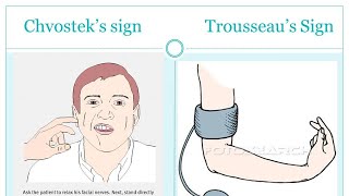 Trousseaus sign of latent tetany [upl. by Eniamrehc128]