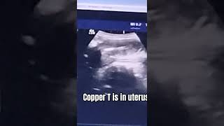 copper T is in uterus [upl. by Fanni585]