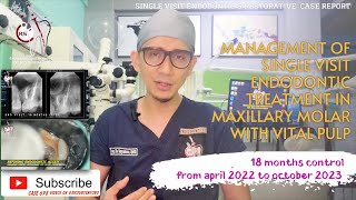 SINGLE VISIT ENDODONTIC TREATMENT 18 MONTHS CONTROL NEGOTIATING MB2 CANAL BIOCERAMIC OBTURATION 🦷 [upl. by Sydel]