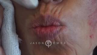 GET BOTOX FOR FINE MOVEMENT LINES amp WRINKLES AROUND THE MOUTH PERIORAL REJUVENATION Dr JASON EMER [upl. by Bluh]