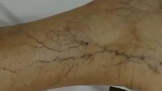 Sclerotherapy for Spider Veins [upl. by Maximo242]