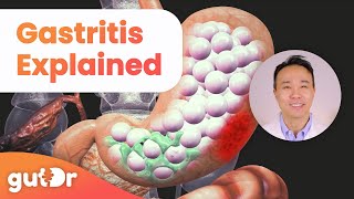 What is Gastritis  The GutDr Explains 3D Gut Animation [upl. by Yrrac]