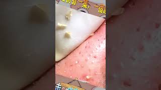 Blackhead Removal Acne Removal Treatment 034 [upl. by Goerke382]