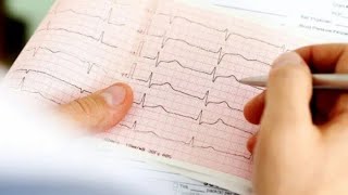 ECG එකක Ectopic Beats රටා කියවන්නට උගනිමු Lets learn to read ECG [upl. by Aria]