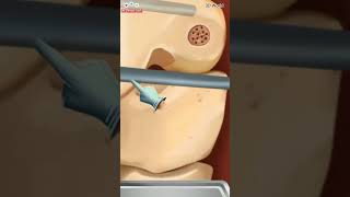 Knee Treatment Surgery With Anthroscope surgeryeducation kneepain kneesurgeon surgeon [upl. by Ringler]