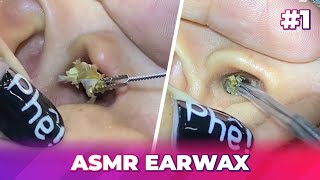 1 Earwax ASMR  Surprised by the dirty ear and how to clean it [upl. by Olyhs]