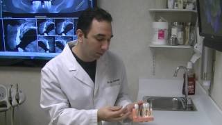 Whats the Difference Between Dental Implants and Bridges [upl. by Sido524]