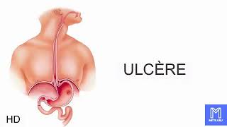 Ulcère causes signes et symptômes diagnostic et traitement [upl. by Simson641]