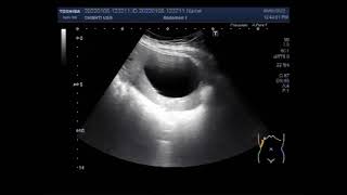 Hydatid Hepatic Cyst [upl. by Lladnar]