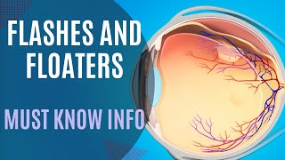 Flashes Floaters Posterior Vitreous Detachment vs Retinal Detachment [upl. by Yewed]