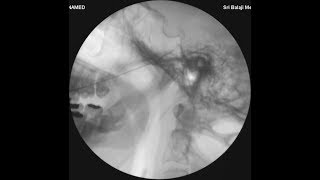 TRIGEMINAL NEURALGIA  RF NERVE ABLATION TREATMENT DR NEERAJ JAIN MD FIMSA CIPSHung FIPPUSA [upl. by Maggio]