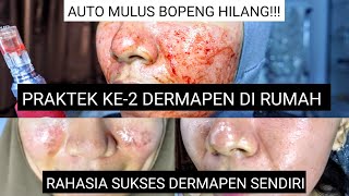 DERMAPEN Update  Praktek Treatment Ke2  PART 1 [upl. by Rocker368]