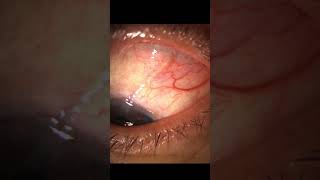 Glaucoma Surgery Ahmed Valve [upl. by Juback709]