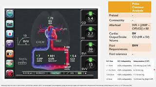 Cardiac Output Monitoring [upl. by Vel]