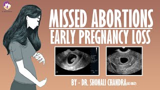 Missed Abortion  Early Pregnancy Loss  Clinical Scenarios  Dr Shonali Chandra [upl. by Neve]