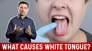 What Causes White Tongue – DrBerg on Oral Candidiasis [upl. by Arndt903]