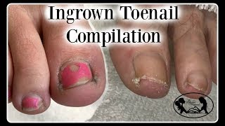 Satisfying Ingrown Toenail Pedicure Compilation [upl. by Talia23]