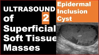 Epidermoid inclusion cyst on Ultrasound [upl. by Yeargain]