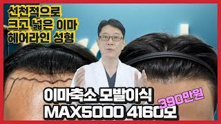 크고 넓은 이마축소 모발이식비용 MAX5000 4160모이식 390만원 [upl. by Otrebla]