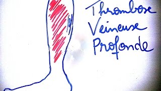 SmartNEasy  Thrombose veineuse profonde  Dr Astuce [upl. by Ainosal]