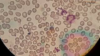 Blood film smear shows normochromic normocytic crenated red cells and aggregation of platelets [upl. by Nivloc405]