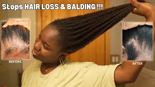 Use This Once a Week and Your Hair Will Never Stop Growing DIY for HAIR LOSS amp BALDING‼️ [upl. by Anyela113]