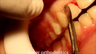 Circumferential supracrestal fiberotomyCSF in rotated teeth after finishing orthodontic treatment [upl. by Eicul]