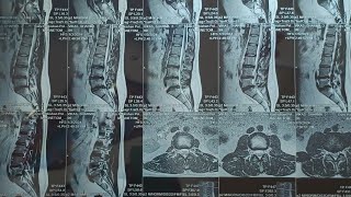 Recovery After Cauda equina syndrome L4 L5 S1 Disc bulgeDisc decompression lower back surgery Disc [upl. by Eerased312]