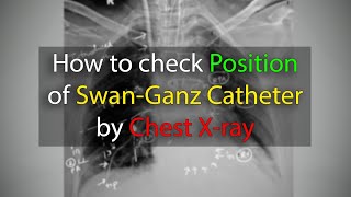 Pulmonary Artery SwanGanz Catheter position check in Chest X ray [upl. by Teuton]