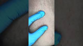 Watch Electrolysis Now Zap Hairs with Me [upl. by Lindi]